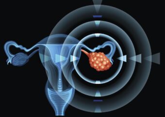 Pouvons-nous prévenir le cancer de l'ovaire?