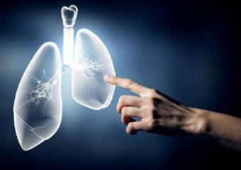 L'échographie endobronchique dans le diagnostic du cancer du poumon