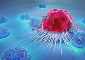 Les origines et les traitements d’une métastase