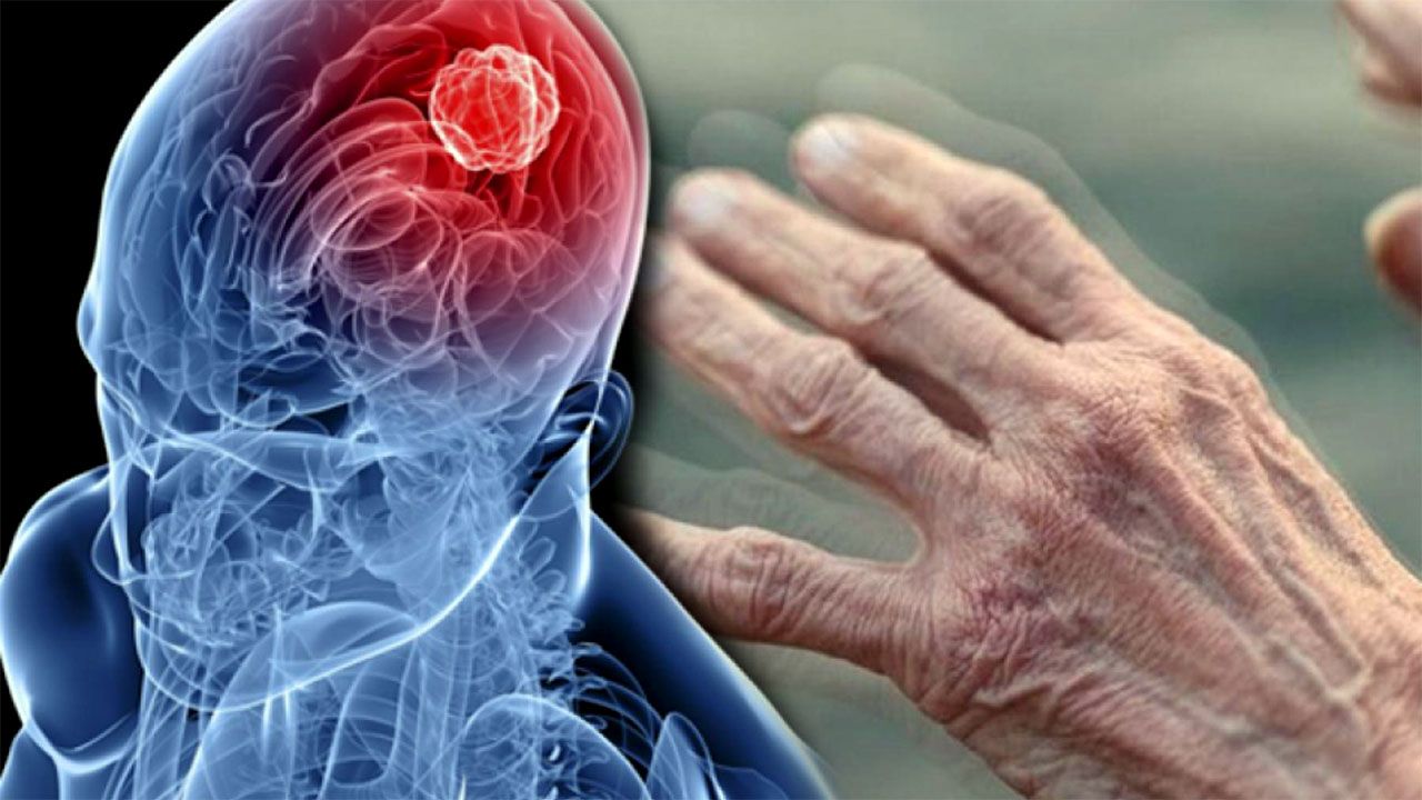 La Chirurgie de la Maladie de Parkinson
